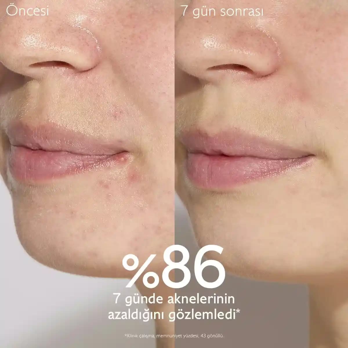 Akne Lekeleri İçin Etkili Serum Kullanımı ve Doğru Bakım Yöntemleri
