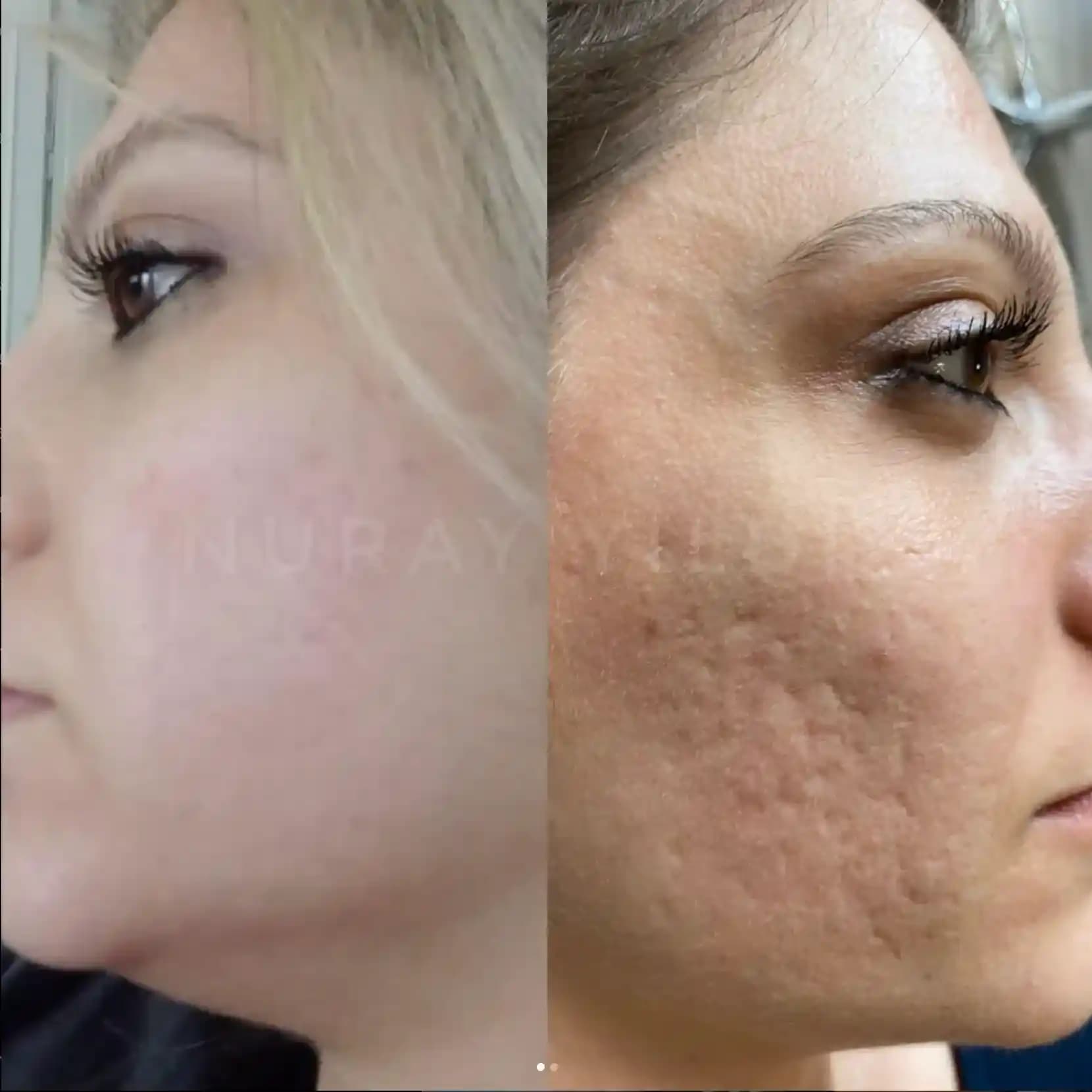 Akne Tedavisinde Pratik ve Etkili Cilt Bakımı Yöntemleri ve Tavsiyeleri