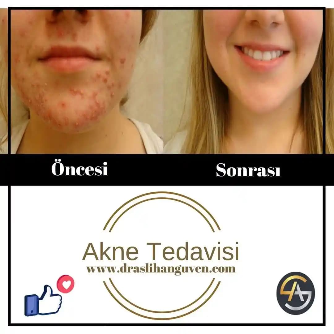 Akne Tedavisinde Yaşam Tarzı ve Beslenme Alışkanlıklarının Önemi