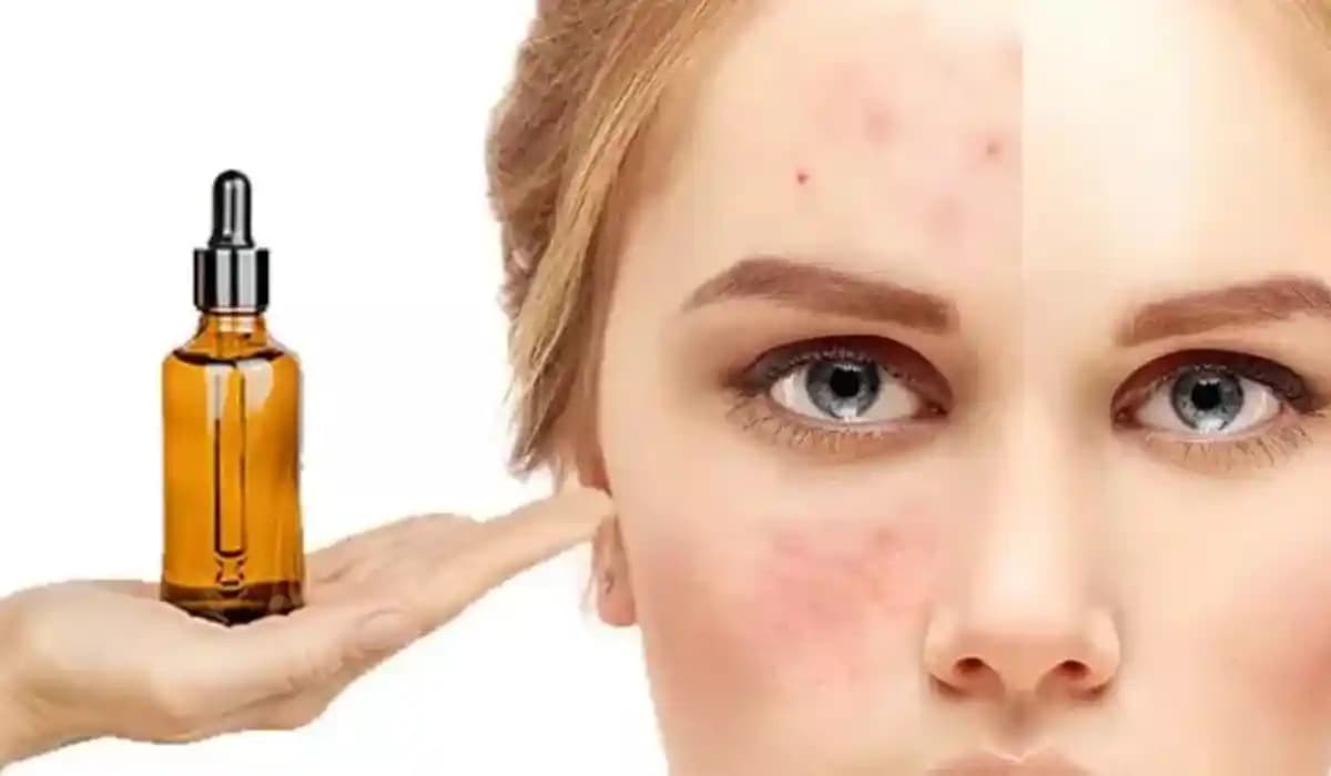 Akneye Karşı Doğal Yağlar ve Kullanım Teknikleri: Etkili ve Güvenli Çözümler