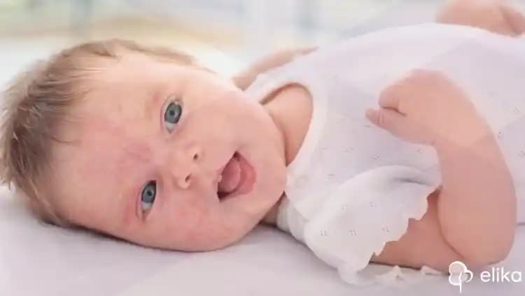 Bebeklerde Akne Nedenleri, Bakım Yöntemleri ve Doğru Yaklaşımlar