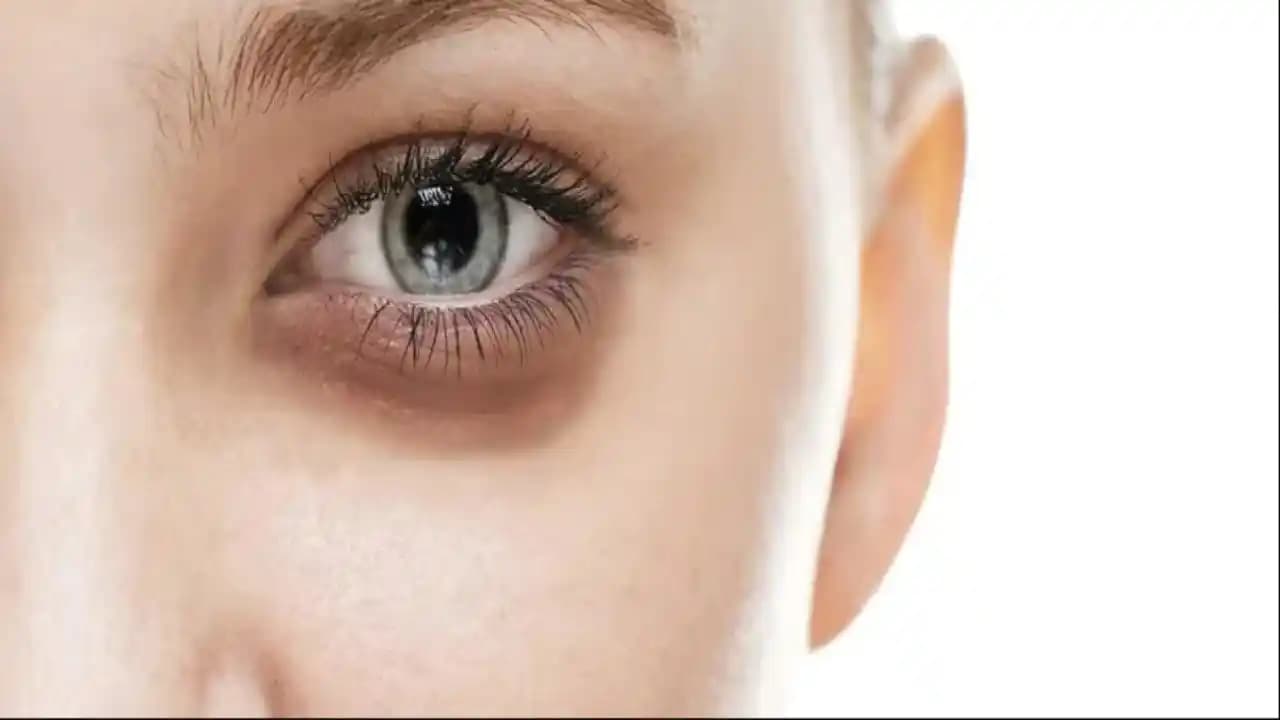 Bebeklerde Göz Altı Morluklarının Nedenleri ve Uygun Bakım Yöntemleri