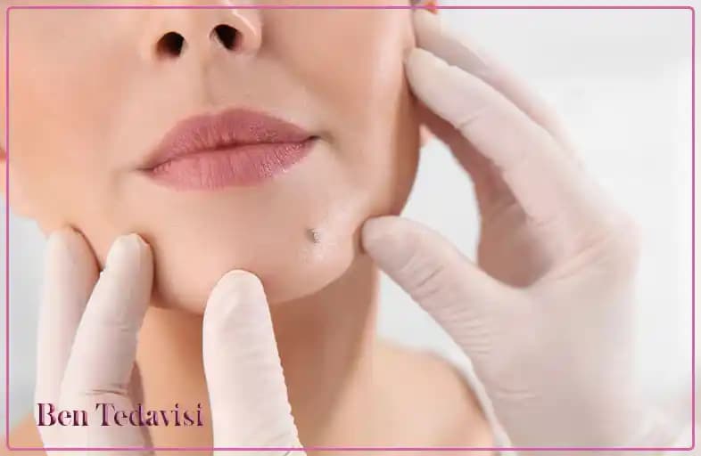 Benlerin Çeşitleri ve Uygun Tedavi Yöntemleri: Cilt Sağlığını Koruma Rehberi