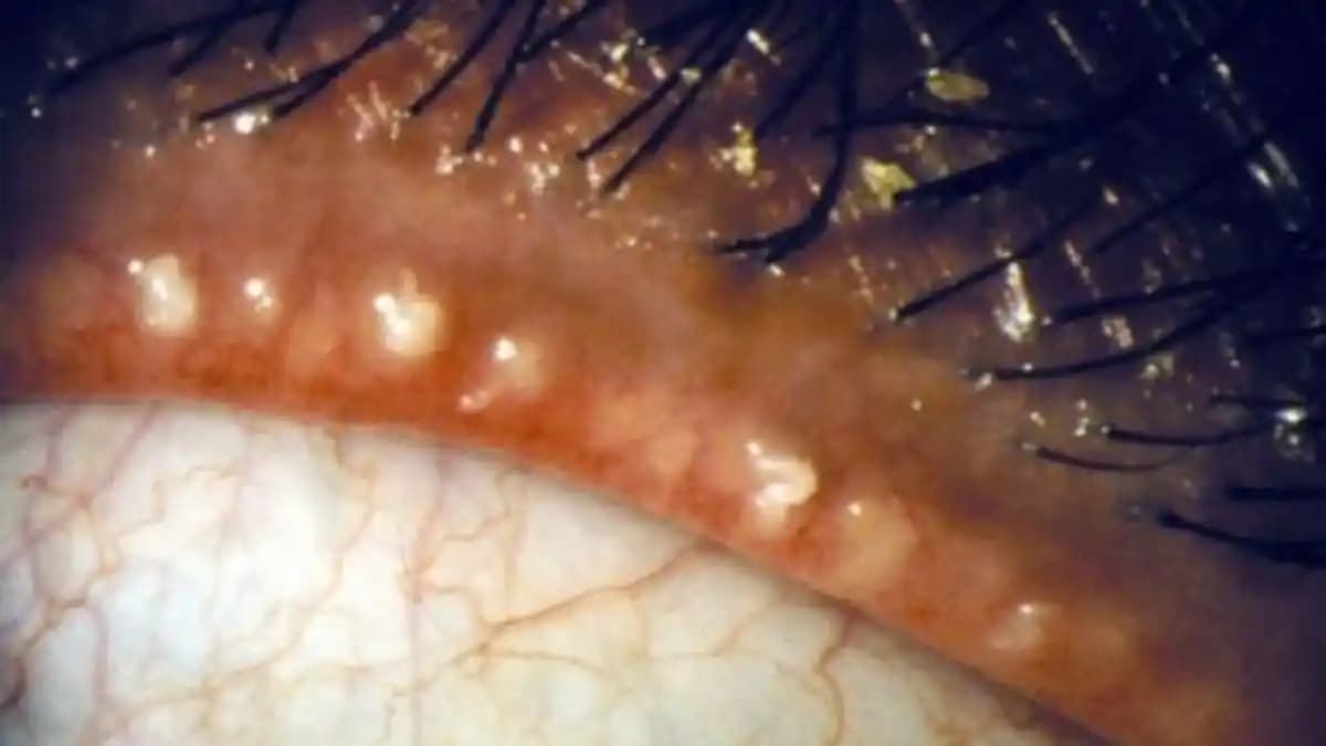 Beyaz Kirpiklerin Nedenleri ve Sağlıkla İlişkisi: Genetik ve Çevresel Faktörler