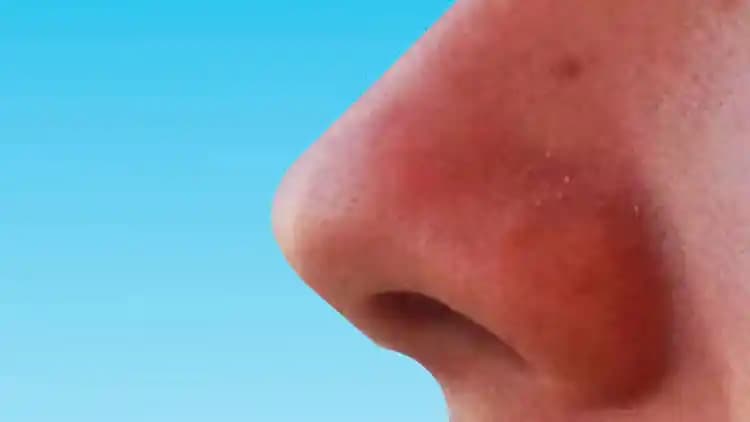 Burun Etrafındaki Kızarıklıkların Nedenleri ve Etkili Tedavi Yöntemleri