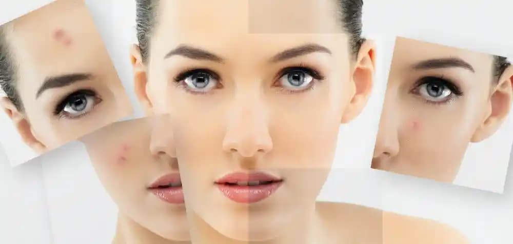 Cilt Lekeleri İçin Dermatolog Tavsiyeleri ve Etkili Tedavi Yöntemleri