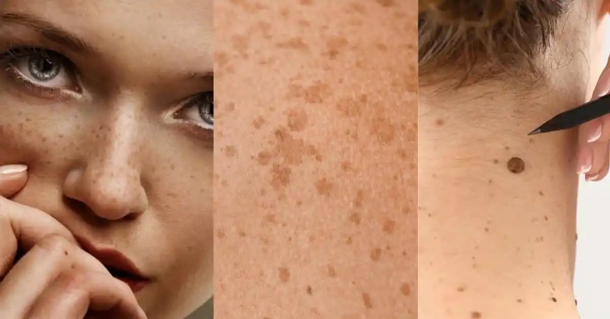 Cilt Lekeleri ve Benleri Koruma Yöntemleri: Etkili Bakım ve Koruma Stratejileri