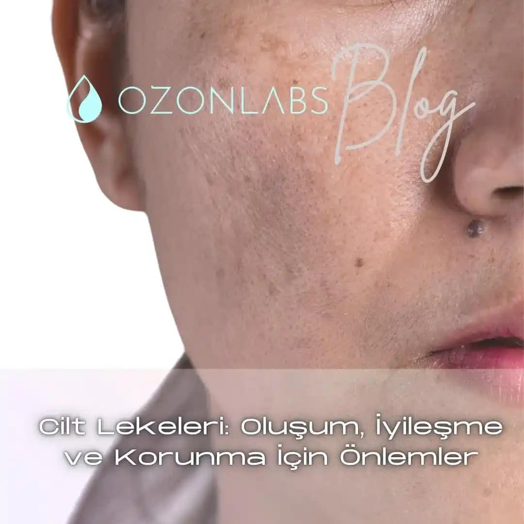 Cilt Lekelerine Karşı Korunma ve Günlük Bakım Yöntemleri Rehberi