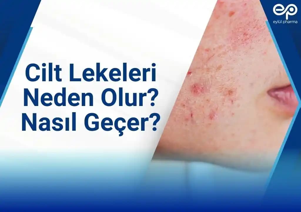 Cilt Lekeleriyle Mücadelede Uzman Tavsiyeleri ve Etkili Tedavi Yöntemleri