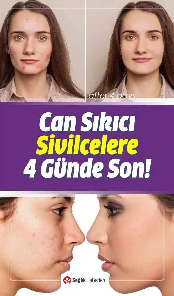 Cilt Sağlığı ve Sivilce Önleme Yöntemleri Bilimsel Yaklaşımlar ve Güncel Bilgiler