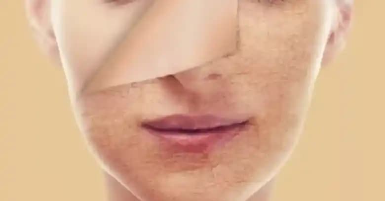 Ciltte Pul Pul Dökülme Sorunu ve Çözüm Yolları: Etkili Bakım ve Tedavi Yaklaşımları