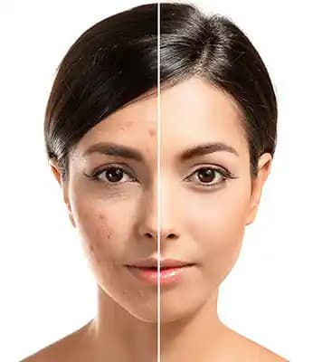 Ciltte Sivilce ve Leke Tedavisinde Güncel Yaklaşımlar ve Etkili Yöntemler