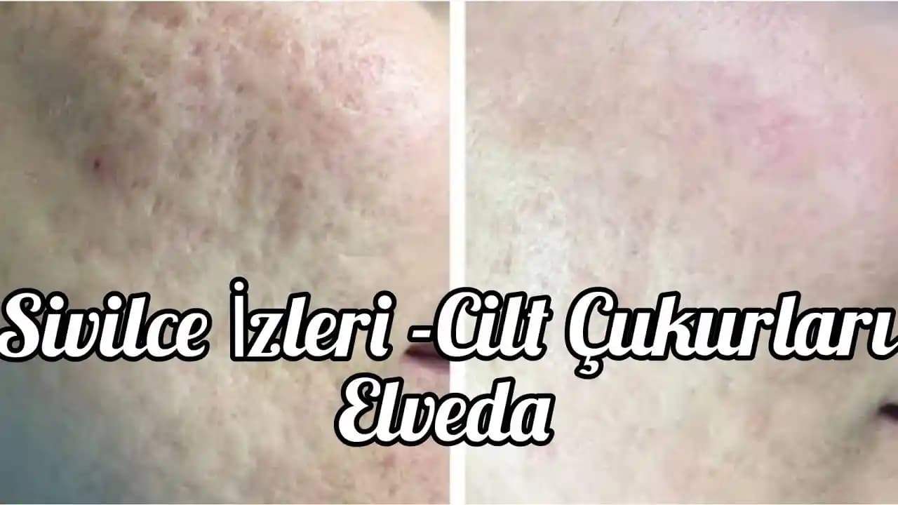 Ciltte Siyah Lekeler İçin Etkili Tedavi Yöntemleri ve Koruyucu Önlemler