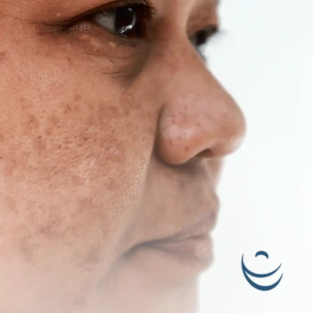 Ciltte Siyah Lekelerin Nedenleri ve Etkili Tedavi Yöntemleri Hakkında Bilgi