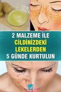 Ciltteki Lekeleri Gidermenin Bilimsel ve Güvenilir Yöntemleri