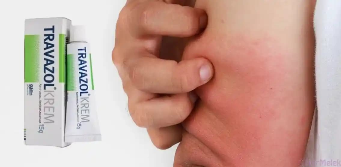 Darbe Şişlikleri İçin En Etkili Krem Seçimi ve Kullanım Rehberi