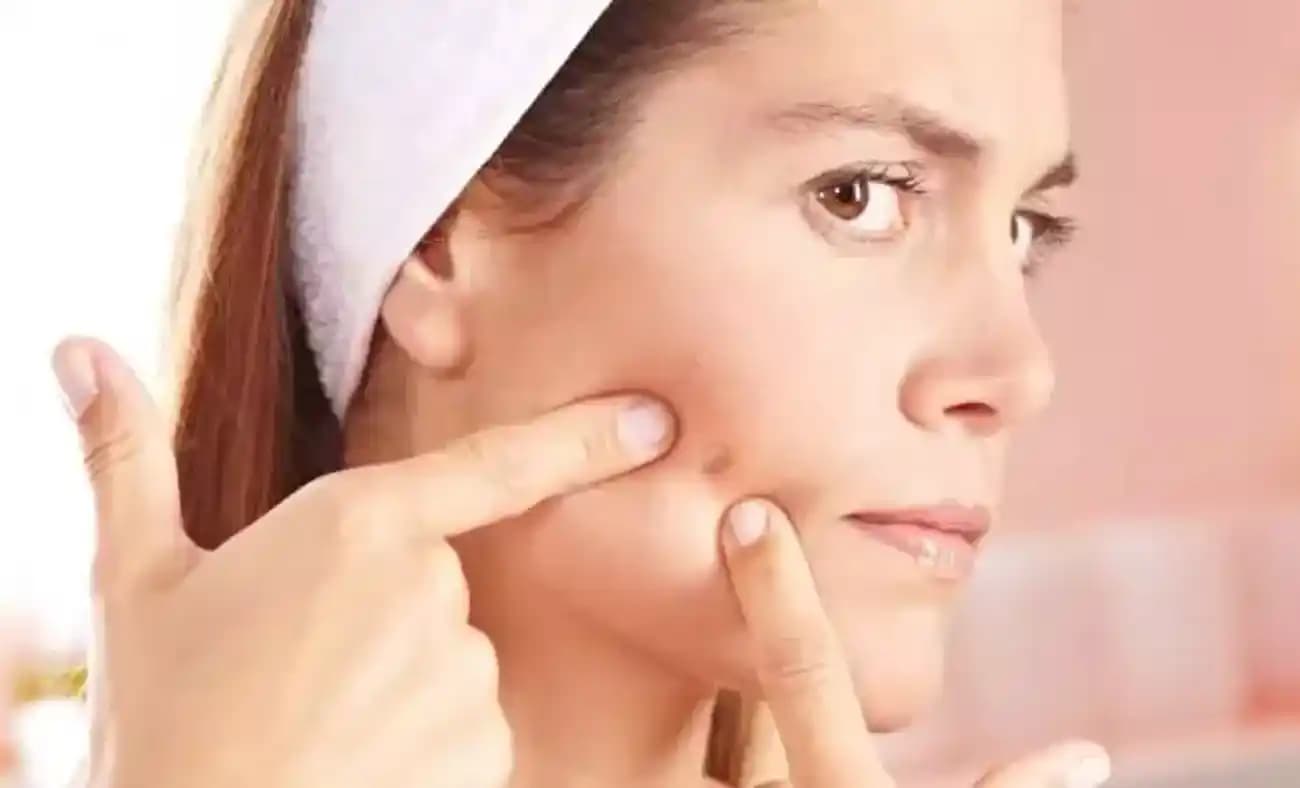 Doğal Bakım Çözümleri ve Sivilceli Ciltler İçin Etkili Yöntemler