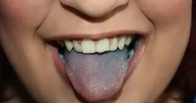 Doğal Dil Pası Tedavi Yöntemleri: Güvenli ve Etkili Alternatifler