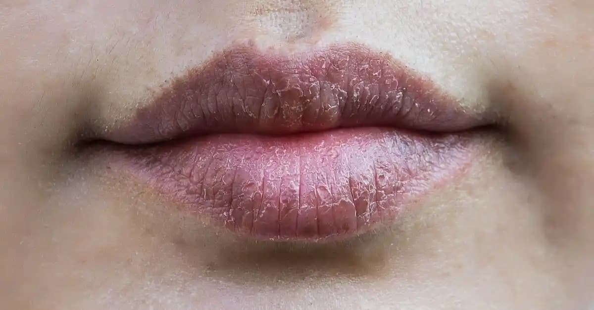 Dudaklarda Çatlaklara Karşı Bilimsel Temelli Etkili Bakım Yöntemleri ve Koruma İpuçları