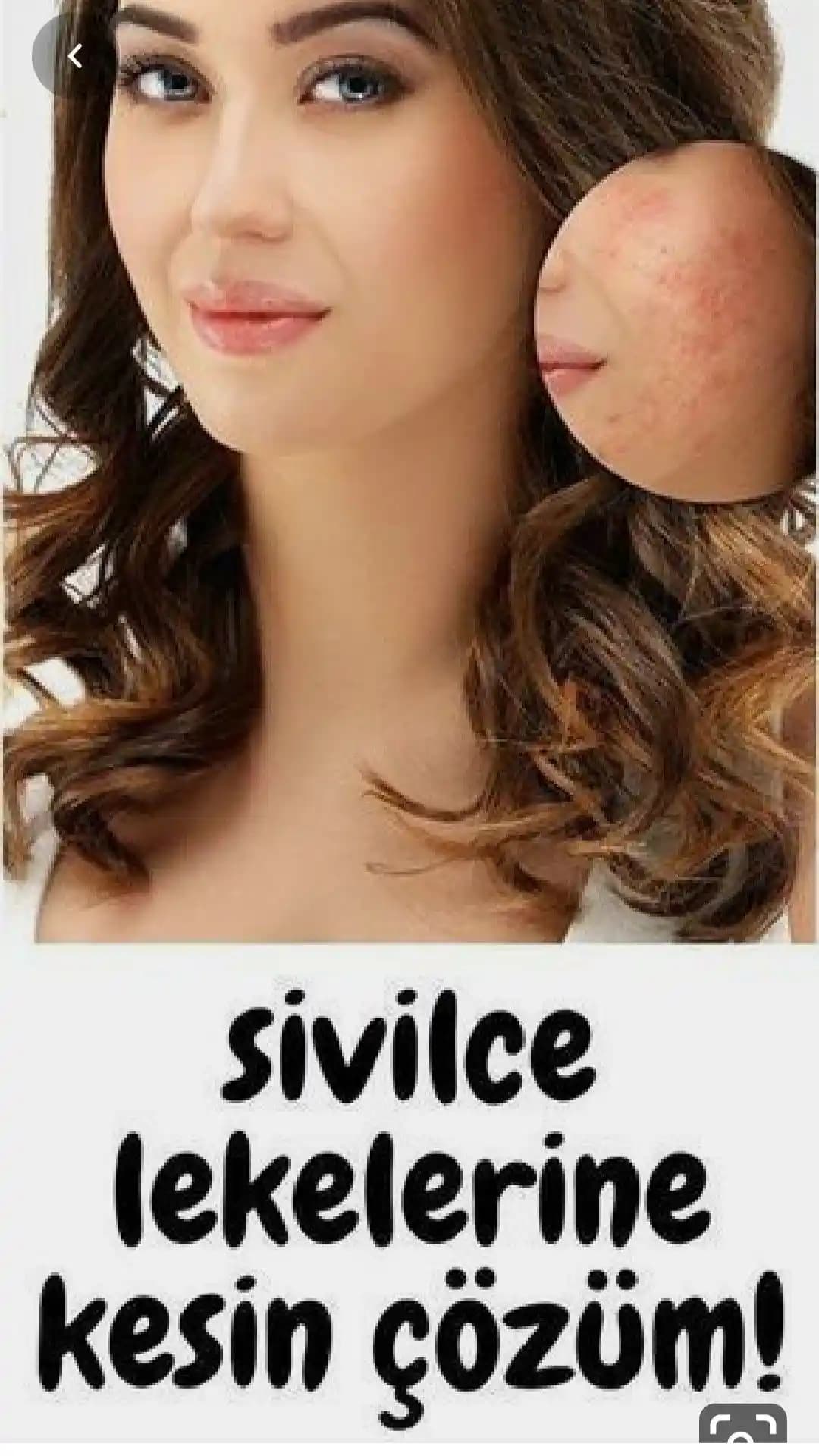 En Etkili Sivilce Tedavi ve Cilt Bakımı Yöntemleri Hakkında Kapsamlı Rehber