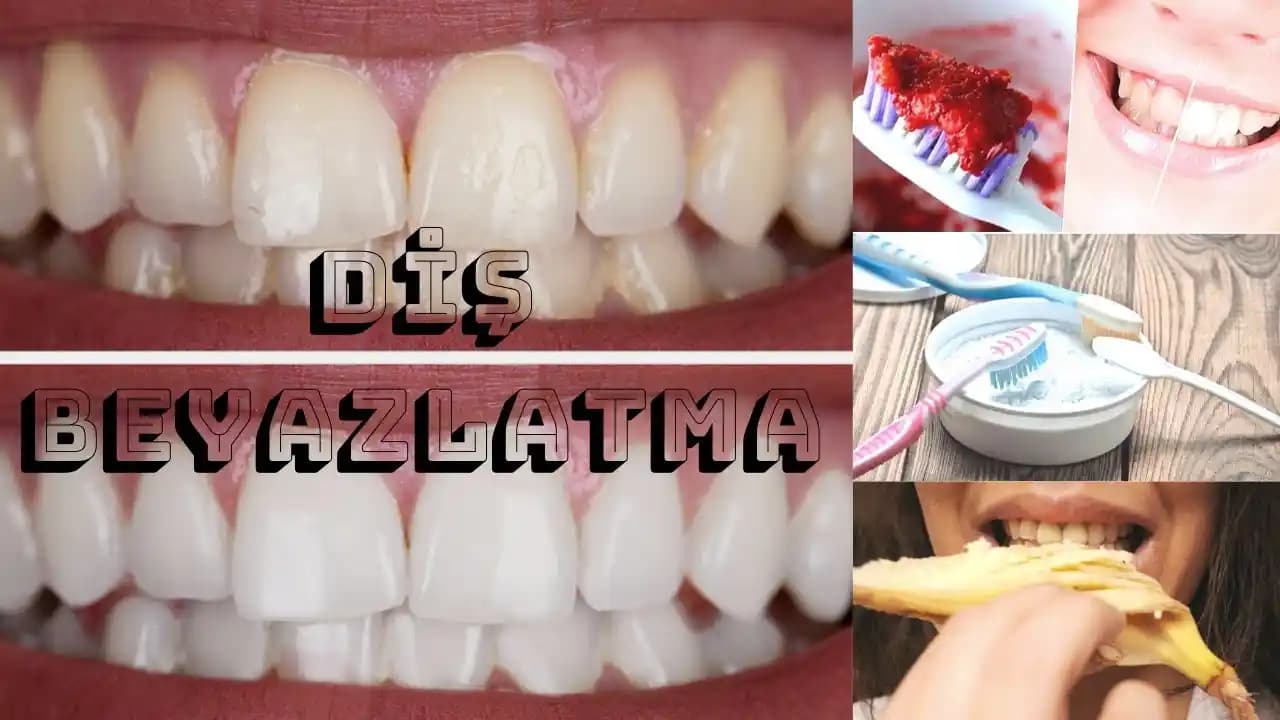 Etkili Diş Beyazlatma Yöntemleri: Güvenilir ve Kalıcı Gülüşler İçin Rehber