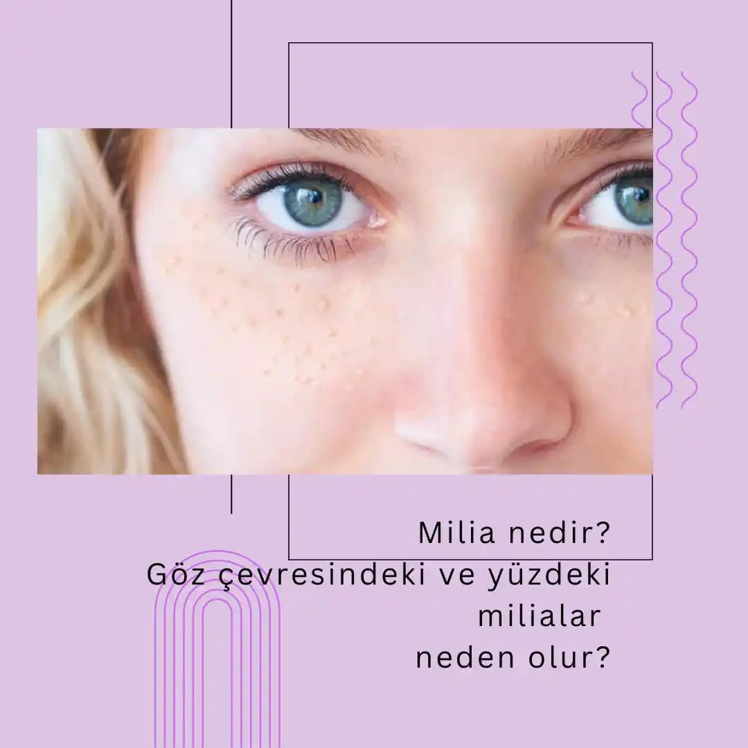 Göz Çevresi Milia: Nedenleri, Belirtileri ve Estetik Çözüm Yöntemleri