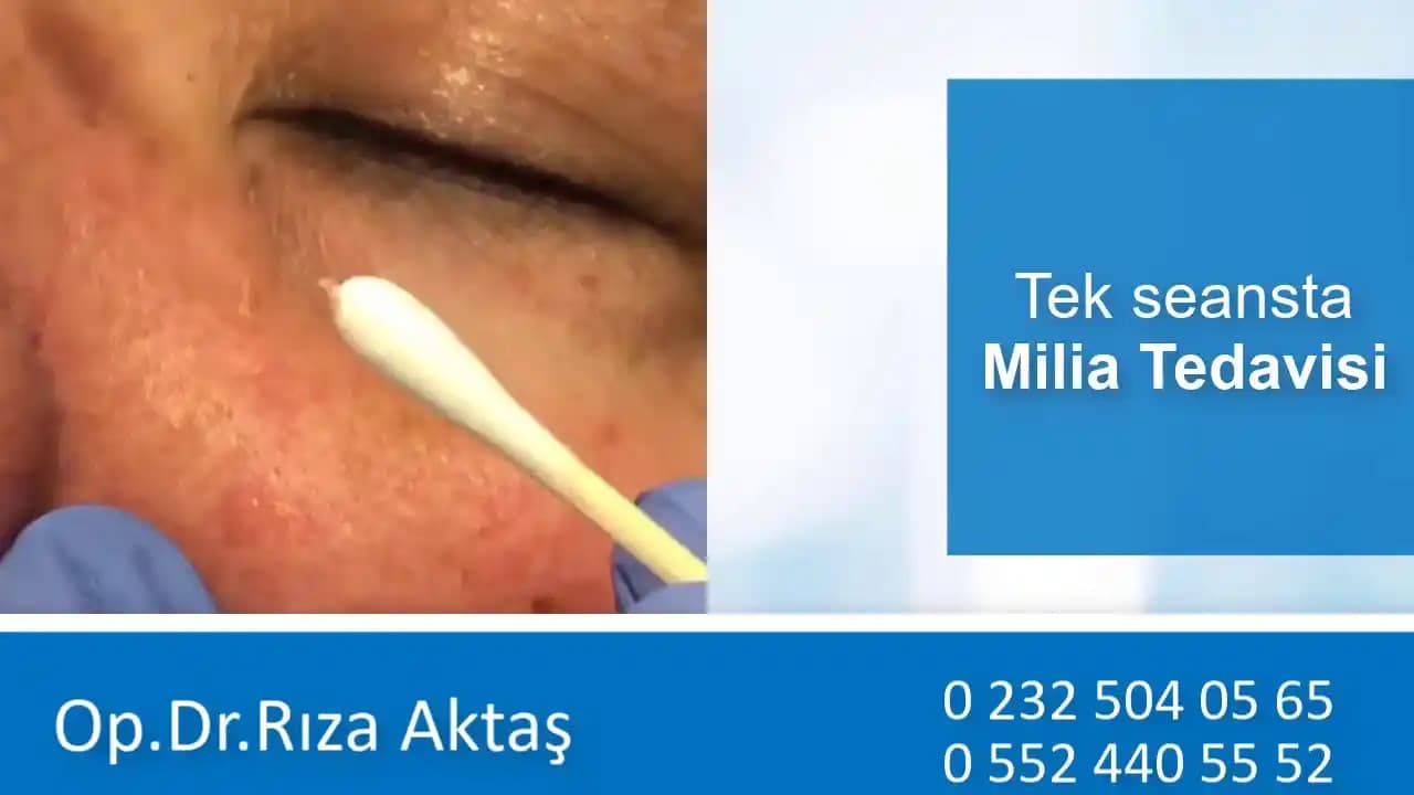 Göz Çevresi Milia Tedavisi: Güvenli ve Etkili Yöntemler Hakkında Bilgi