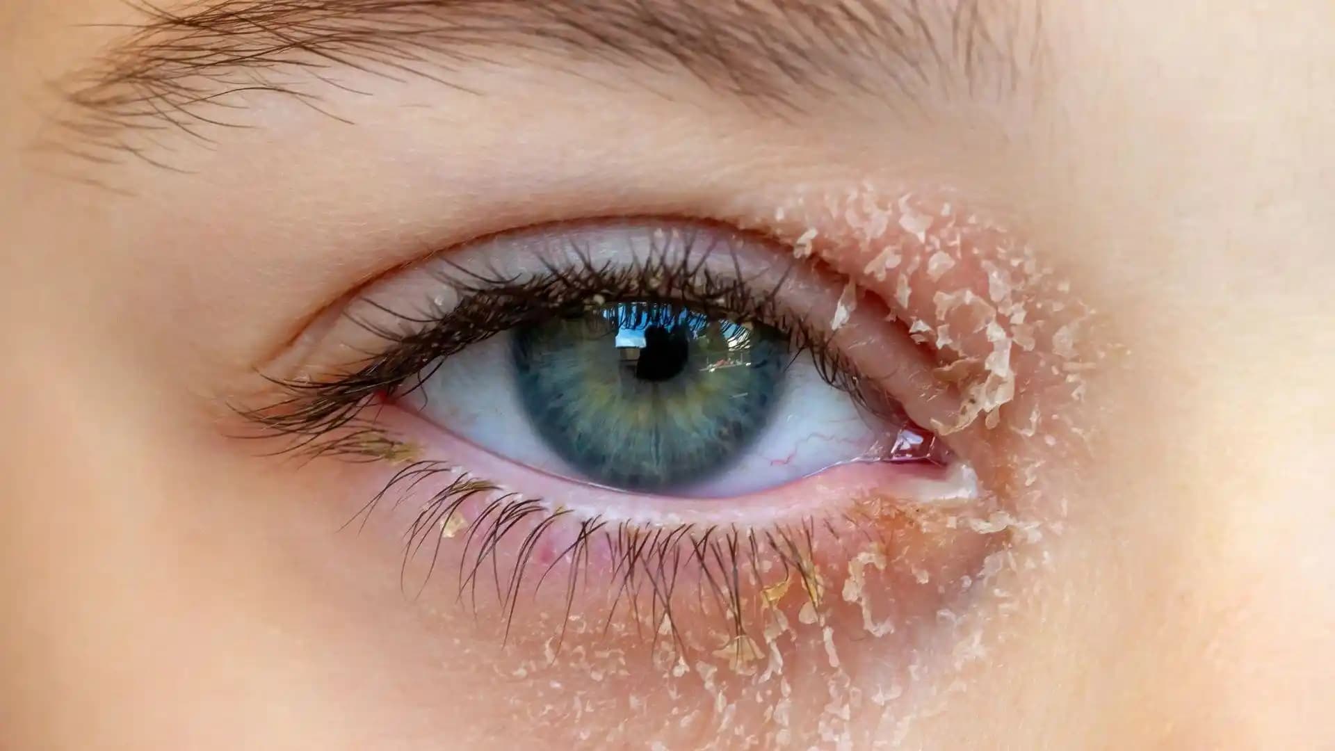 Göz Egzaması Belirtileri, Nedenleri ve Etkili Tedavi Yöntemleri Hakkında Bilgi