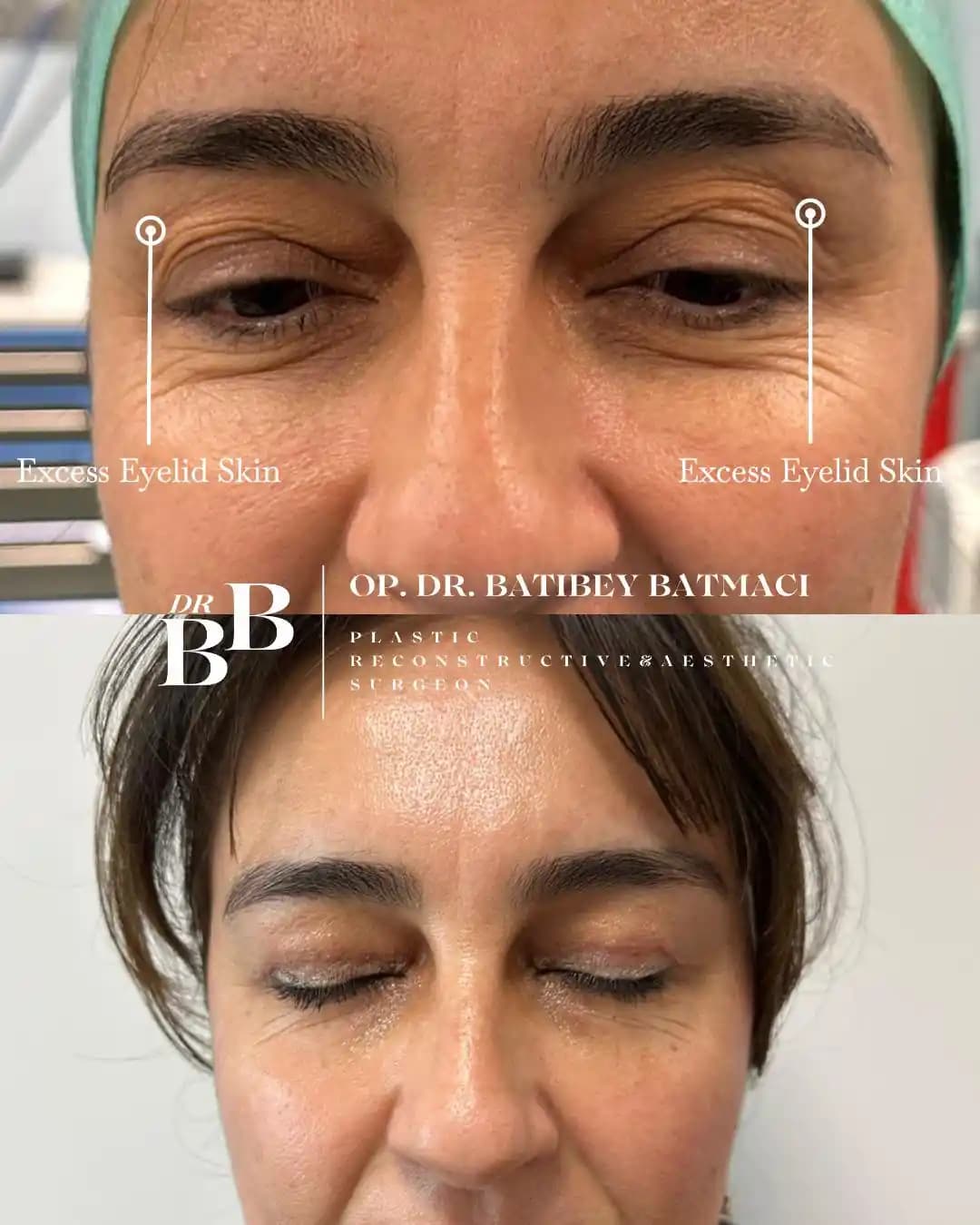 Göz Kapağı Estetiğinde Kalıtım Bantlarının Kullanımı ve Avantajları