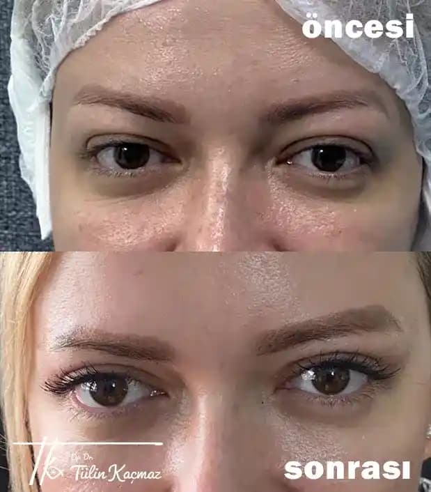 Göz Kapaklarında Estetik ve Konfor: Güncel Yaklaşımlar ve Gelecek Trendleri