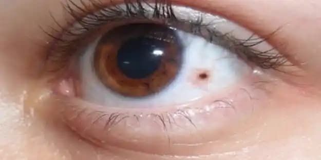 Gözde Leke ve Benlerin Nedenleri: Genetik, Çevresel ve Yaş Faktörleri Üzerinden Bilinçli Bir Bakış