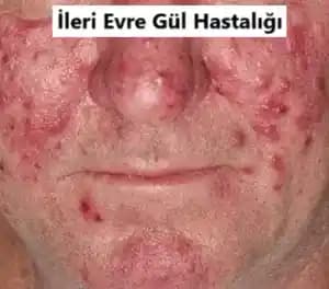 Gül Hastalığı ve Beslenme: Tetkik ve Bakım İpuçlarıyla Cilt Sağlığını Koruma