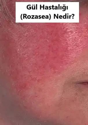 Gül Hastalığına Yönelik Güncel Beslenme ve Kozmetik Yaklaşımları