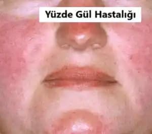 Gül Hastalığında Kozmetik Kullanımı: Güvenli ve Bilinçli Cilt Bakım Yöntemleri