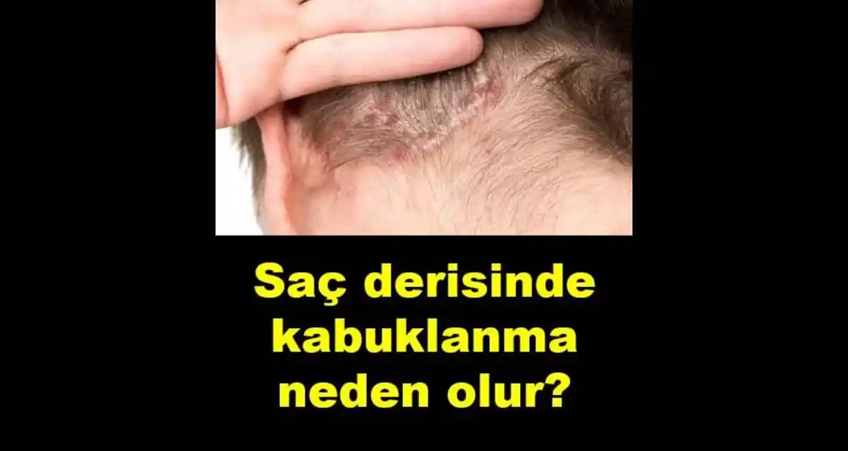 Kabuklanma Nedenleri Belirtileri ve Etkili Çözüm Yöntemleri Hakkında Bilgiler