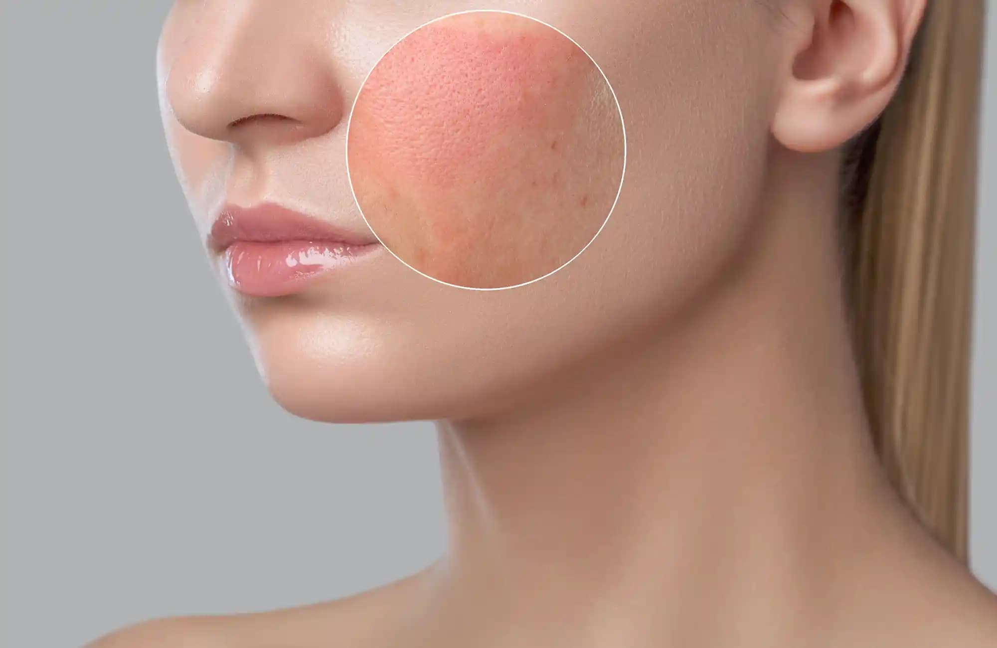 Kızarıklık Nedenleri ve Etkili Tedavi Yöntemleri Hakkında Kapsamlı Bilgi