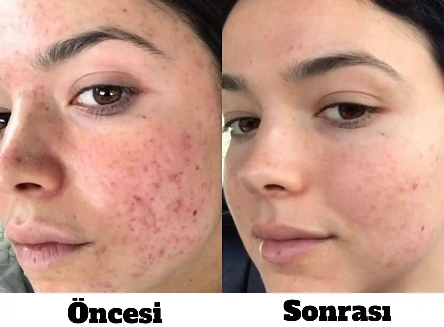 Koldaki Sivilce İzleri İçin Etkili Bakım Yöntemleri ve Cilt Sağlığı İpuçları