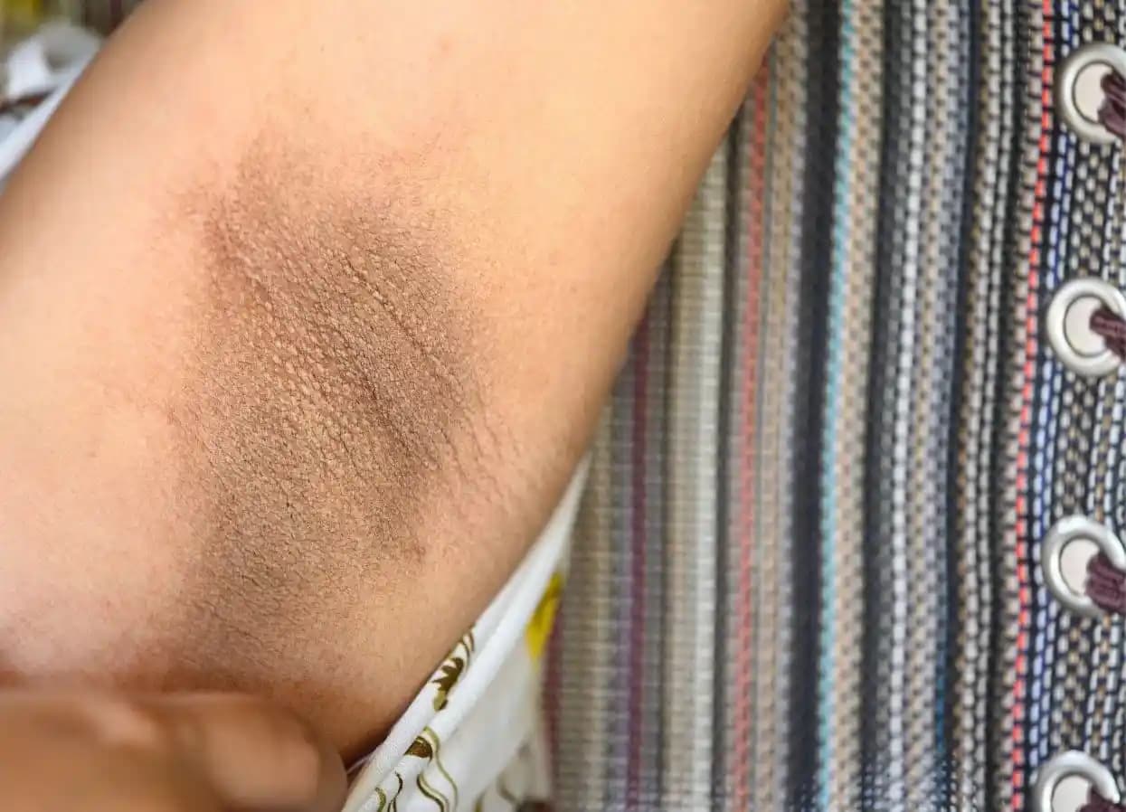 Koltuk Altı Kararması Nedenleri ve Etkili Çözüm Yolları Hakkında Bilmeniz Gerekenler