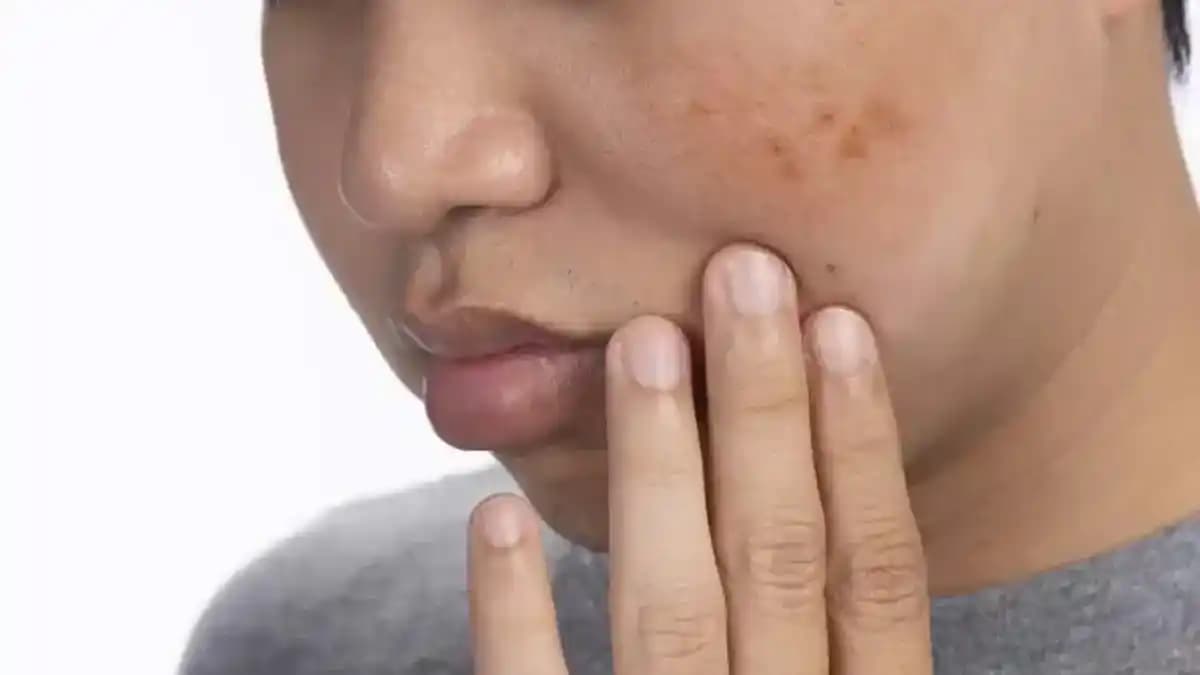 Leke ve Benlerin Tedavi Yöntemleri ile Korunma Stratejileri