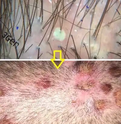 Saç Derisi Aknesi ve Folikülit: Belirtiler, Nedenler ve Etkili Bakım Yöntemleri