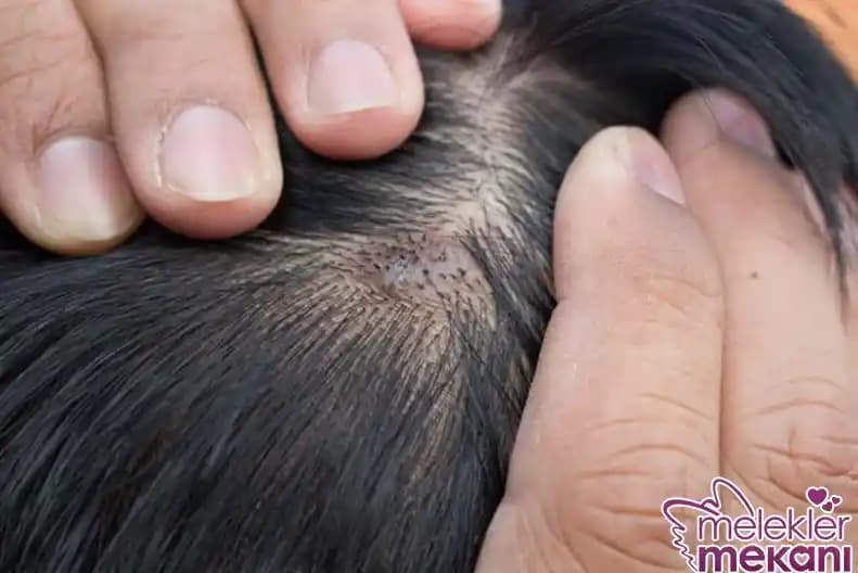 Saç Derisi Folikülit ve Akne Tedavisi: Güncel Yaklaşımlar ve Etkili Yöntemler