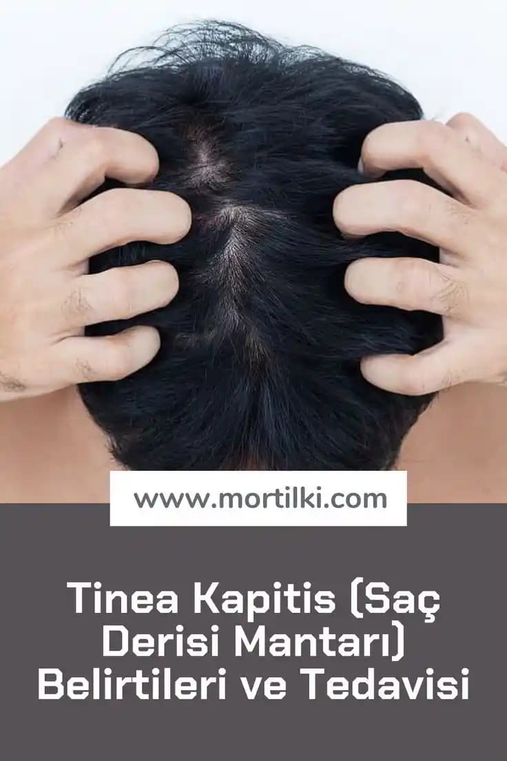 Saç Derisi İltihabı Belirtileri ve Etkili Tedavi Yöntemleri Hakkında Kapsamlı Bilgi