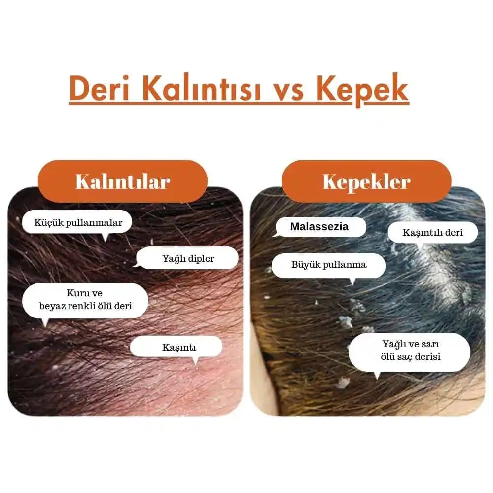 Saç Derisi Kepek Belirtileri ve Etkili Bakım Yöntemleri Hakkında Bilmeniz Gerekenler