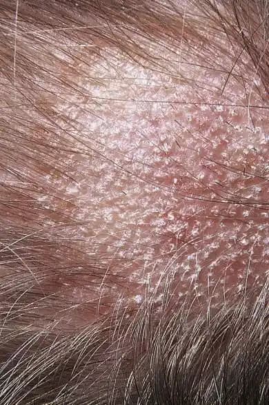 Saç Derisi Mantar Problemi: Belirtileri, Nedenleri ve Etkili Tedavi Yöntemleri