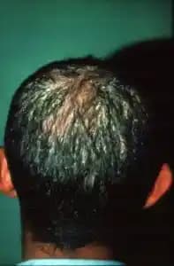 Saç Derisinde Mantar Sorunu: Belirtileri, Nedenleri ve Etkili Tedavi Yöntemleri