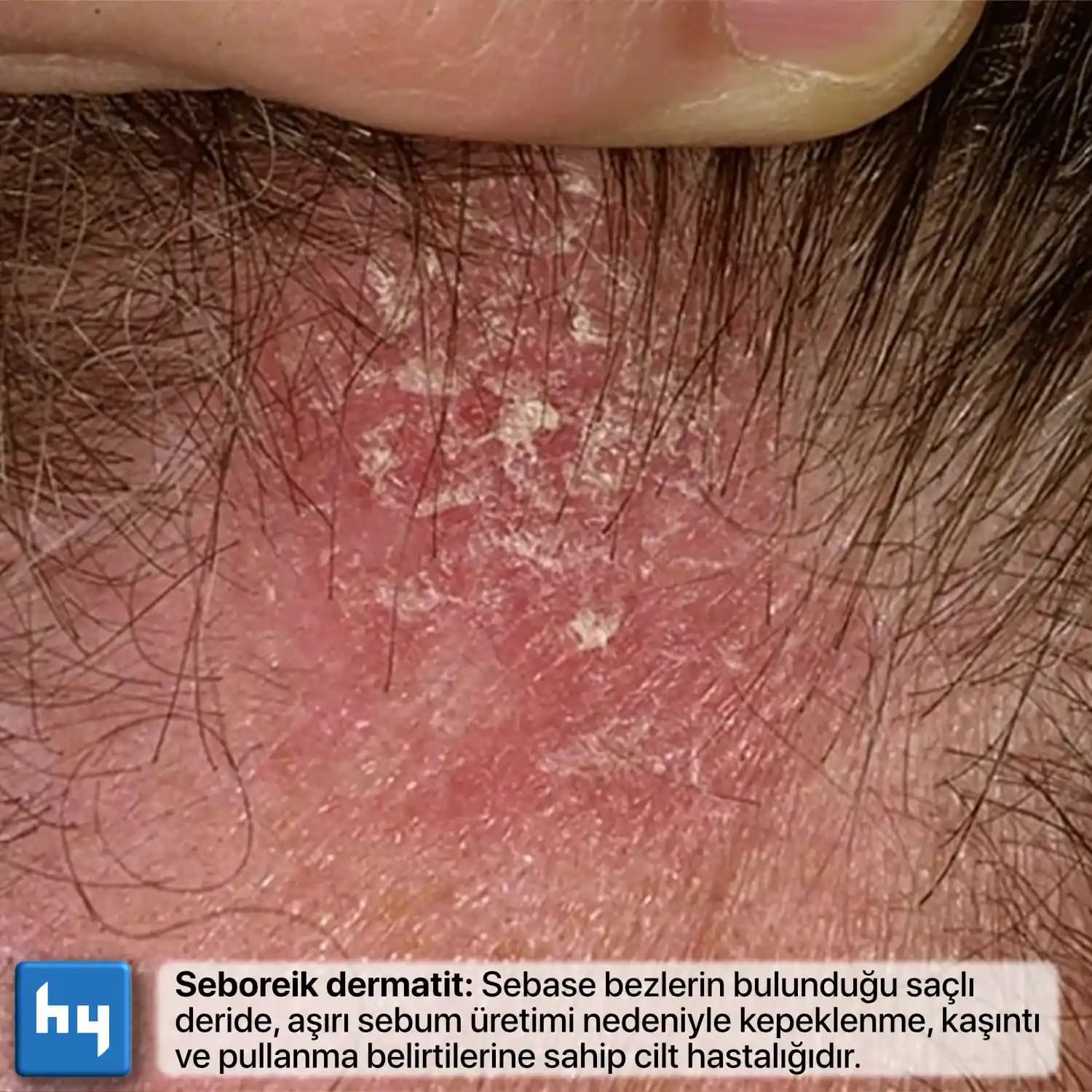 Seboreik Dermatitin Belirtileri ve Cilt Sağlığını Koruma Yöntemleri