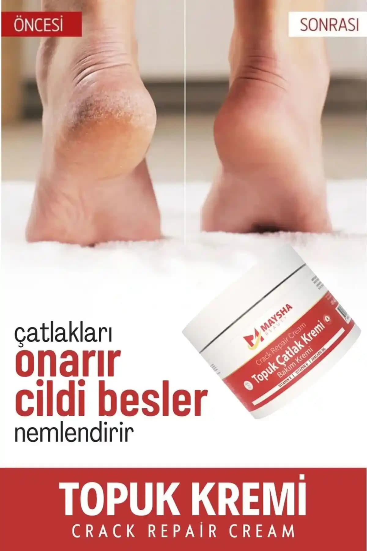 Topuk Çatlaklarını Önlemek ve Hafifletmek İçin Etkili ve Pratik Yöntemler