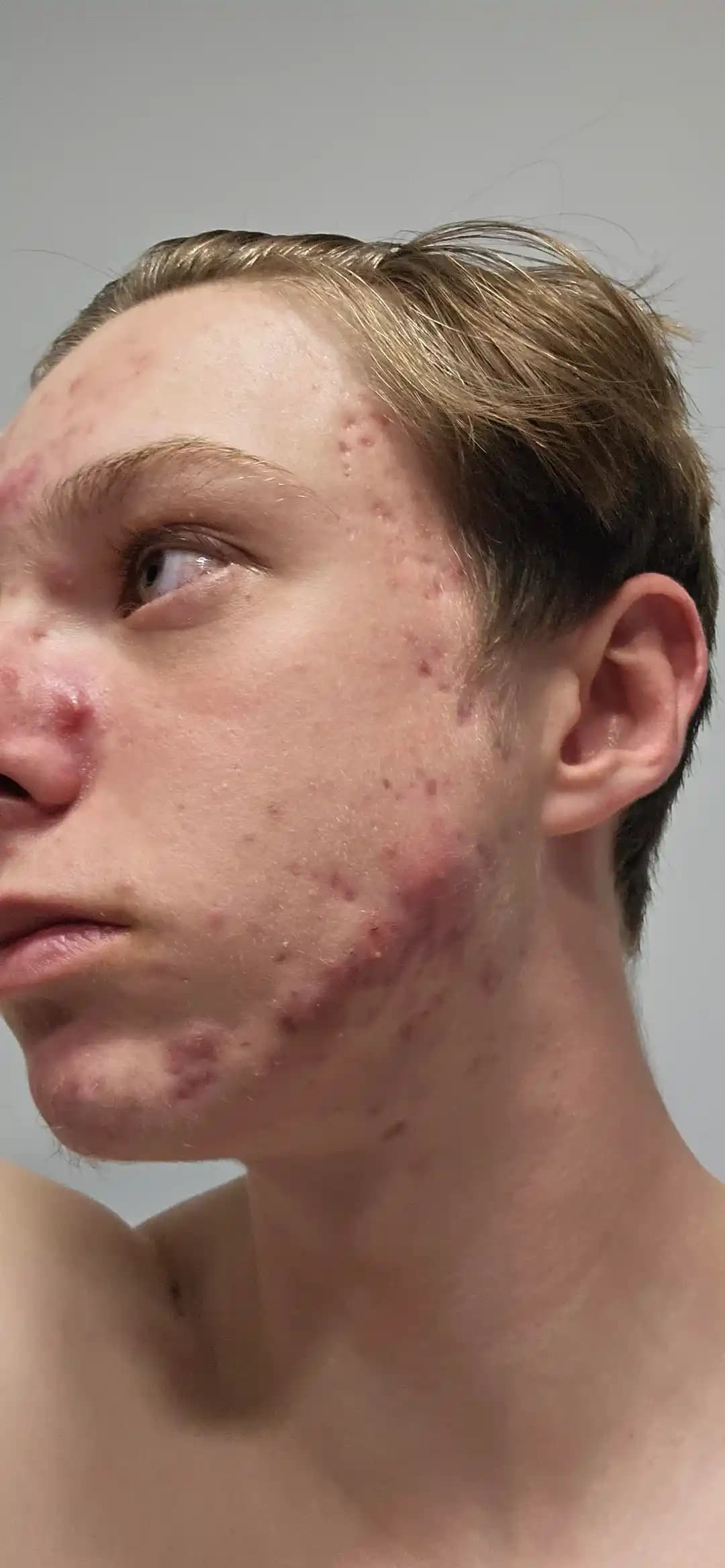 Akne Tedavisinde Diyet Değişikliği ve Accutane Kullanımının Rolü ve Etkinliği