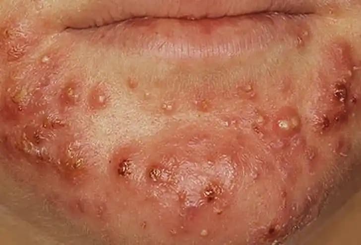 Akne Tedavisinde Doğru Dermatolog Seçimi ve Etkili İlaç Kullanımının Önemi