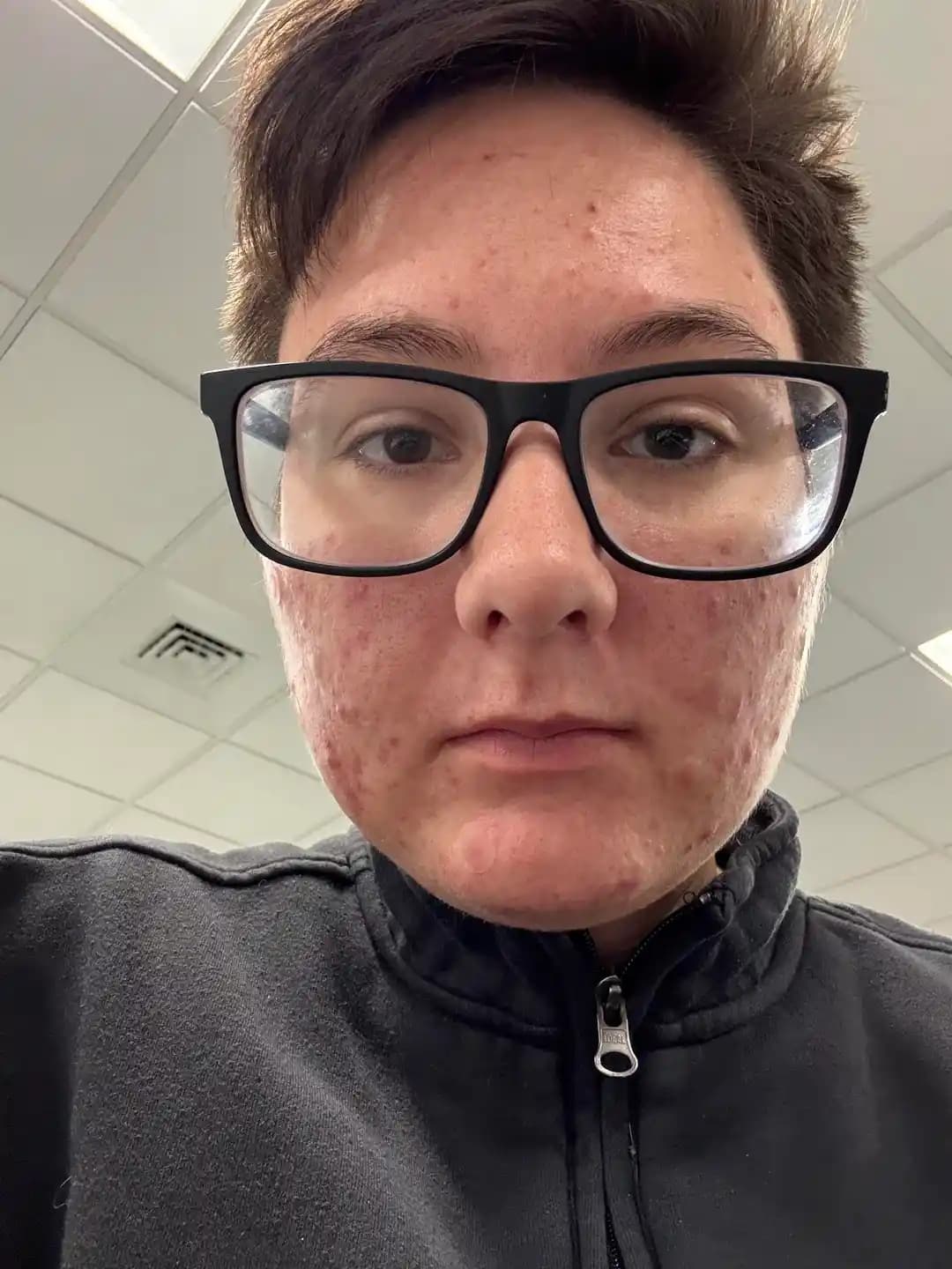 Akne Tedavisinde Doz Ayarı ve Cilt Bakımının Önemi: Doğru Ürün Seçimi ve Uygulama